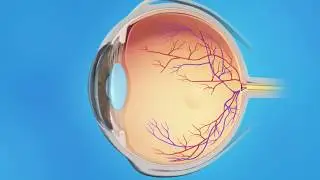 Edema macular cistoide: inyecciones de medicamentos