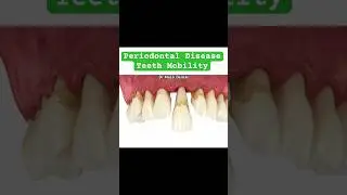 Periodontal Disease, Teeth Mobility