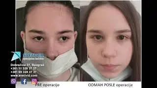Operacija strabizma na oba oka, specijalna bolnica Sveti Vid