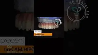 Titanium BAR with Bredent HiPC#bredent#implant s#implantdentistry #composite #screw retained