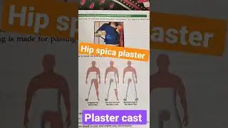 #plaster Hip spica plaster cast 🦴🧑&zwj;⚕️