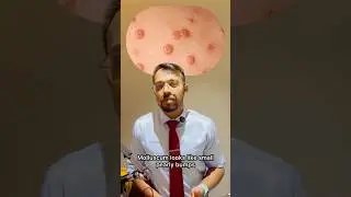 Molluscum Contagiousum Vs Viral warts