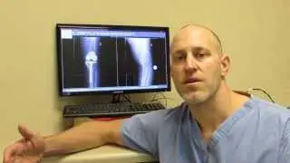 How Do I Know If I Need a Knee Replacement?