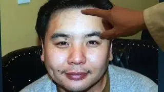 Natural & Dense Hair Transplant Results | 1-Year FUE Transformation