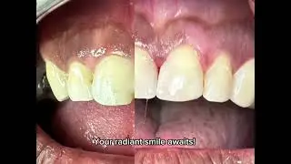 Fractured Front Tooth Repair &ndash; Natural Cosmetic Restoration at Prime Dentistry, Philadelphia