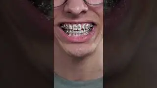 Braces Journey: Manual Vs Electric Toothbrush