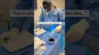 This is how we change lives of men. Expert surgery, real results #viral #behindthescenes #menshealth