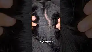 Top 3 Anti Dandruff shampoos