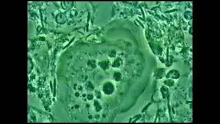 Periodontitis Dysbiosis and Inflammation in active disease. A neglected parasitic disease
