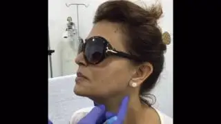 Injection d'acide hyaluronique pour l'ovale du visage par Dr Fayçal El Kouhen