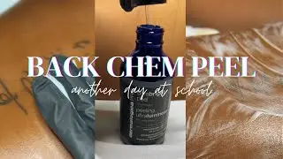 Back Chemical Peel | Dermalogica Ultrabright Peel | SkinsetLLC