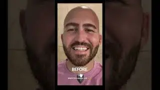 Real Client Review - W/ Cosmetic Incredibil&trade; Veneers