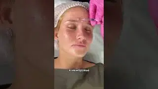 Самый популярный и действенный укол красоты - ботокс 💉 INST: kuuerbaeva.g baeva #косметолог