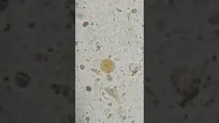 Entamoeba coli in stool (E. Coli)