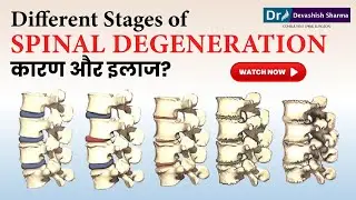 Different Stages of Spinal Degeneration | Degenerative Disc Disease Treatment In India -Dr Devashish