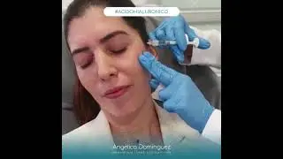 Aplicación de Ácido Hialurónico - Dr. Angélica Domínguez Dermatóloga en Bogotá