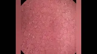 Benign Brenners Tumor of Ovary #incidentalovariantumor #transitionalepithelium #calcification 