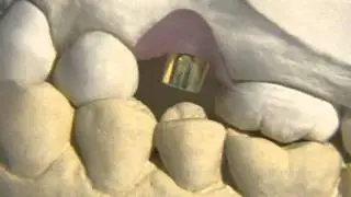 Replace Missing Tooth with Dental Implant and Crown