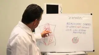 Exparel drug for time-released pain relief after surgery