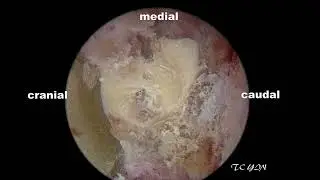 UBE decompression for the nerve  impingement  by a cage