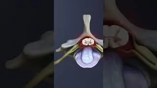 Compression of the Spinal Cord at the C6-C7 Spinal Level