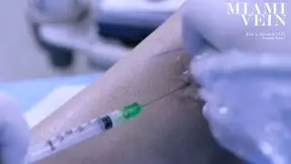 Sclerotherapy Treatment Preparations at the Miami Vein Center