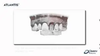 ATLANTIS Abutment Insertion Guide Handling