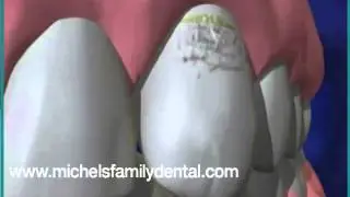 Dental Implants Michels Family Dental La Mesa