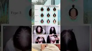 Pcos & hormonal hair loss