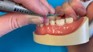Left Handed Probing Molar   SD 480p