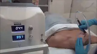 Silkpeel Dermalinfusion Montreal - Microdermabrasion Facial Treatment