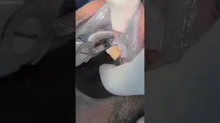 Extraction of remaining root #dentist
