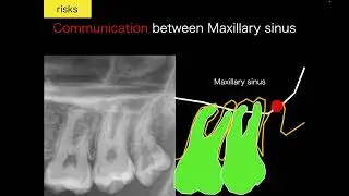 Tooth Extraction