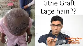 Count and tell, how many grafts in Picture.