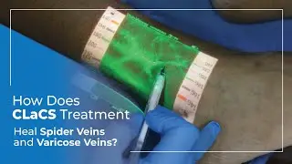 How Does CLaCS Treatment Heal Spider Veins and Varicose Veins? | Avis Hospitals