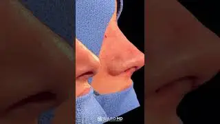 Rhinoplasty Before & After