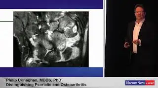 RheumNow Live Preview with Dr. Philip Conaghan (Distinguishing PsA from OA)