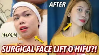 NAGPA-SURGICAL FACE LIFT AKO O HIFU?! MASAKIT BA? | FT. VANDARAH | VLOG#65 Candy Inoue ♥️