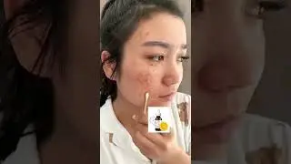 Viral Skin Freckles Removal Serum (💫 Order Link in Description)#beauty #trending #viral