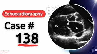 ECHO CASE 138: Echocardiography Spot Diagnosis Series