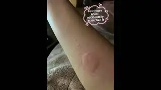 My TB skin test result #Tubercolosis #TST