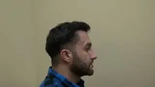 FUE Hair Transplant Doctor San Francisco San Jose California Surgery Bald Hair Loss Treatment