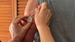 Continuous Glucose Monitoring (CGM) Device Removal with Detachol Adhesive Remover