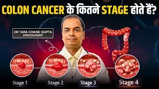Colon Cancer के कितने Stages होते है? | Cancer के हर Stage के कारण और इलाज