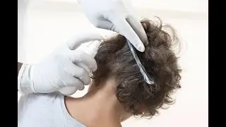 Mayo Clinic Minute - Debunking head lice myths
