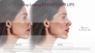 JUV&Eacute;DERM&reg; Before & After