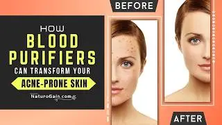 Which Blood Purifier Supplements Work Best for Acne and Pimples?