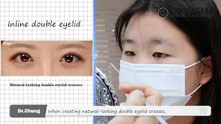 [Plastic Surgery] [Plastic Surgery Korea] Real consultation for high school student&rsquo;s eye surgery