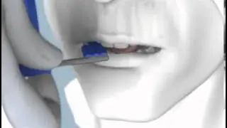 Horizontal Bitewing Sensor Placement