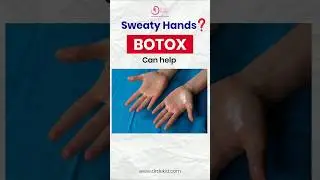 Excessive sweating? #botox #hyperhidrosis #sweating #underarmwhitening #cosmeticsurgery #prp